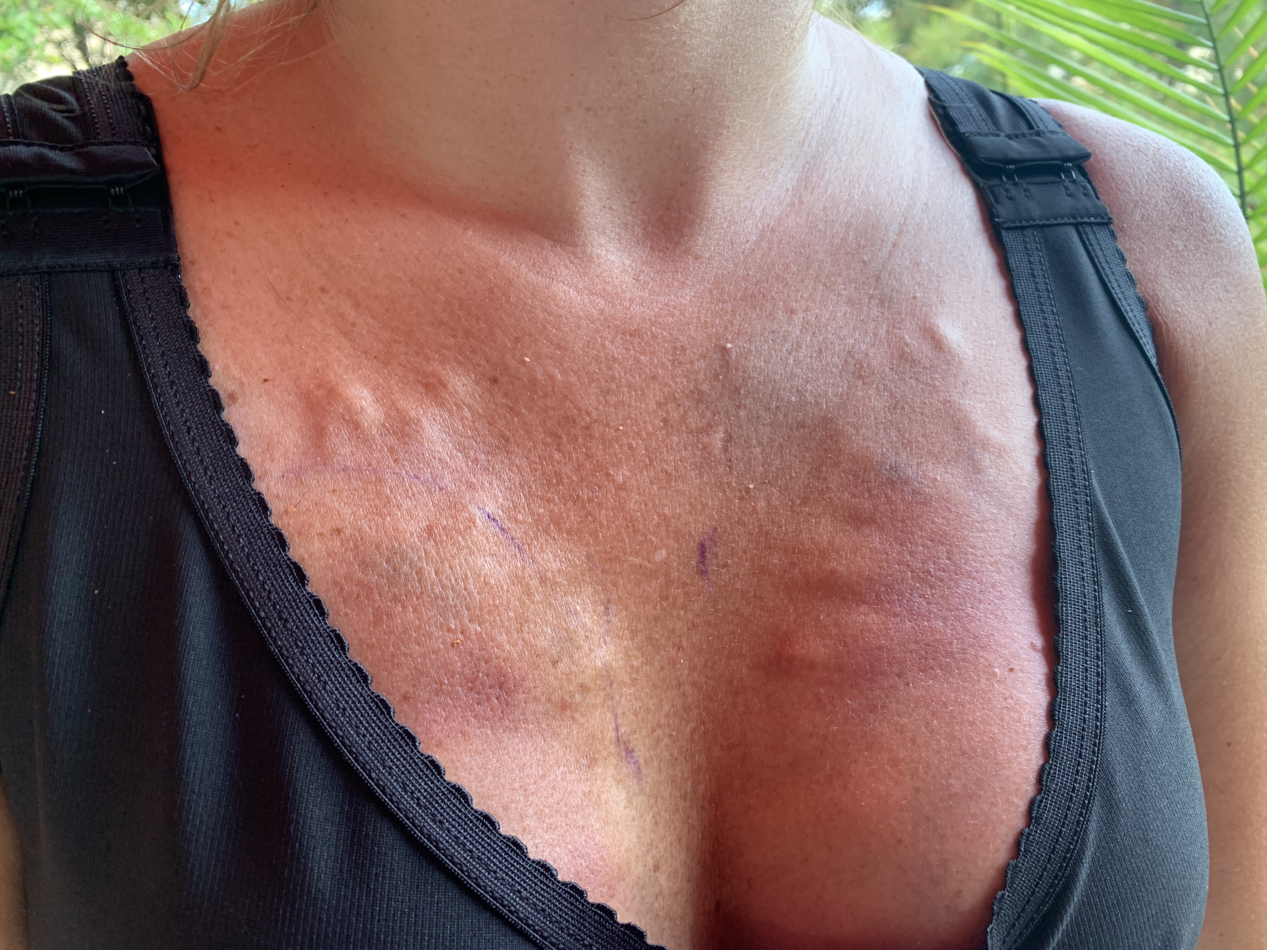 Fat grafting same day